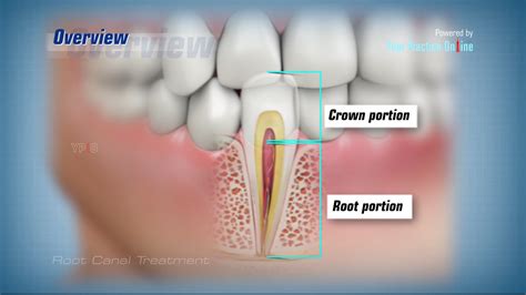 Root Canal Video | Tooth Decay Treatment Video | Dental Video Library