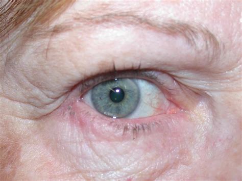 How Blepharitis Is Treated