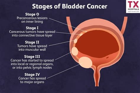 Bladder Cancer Risk Factors, and Treatment Options | TX Hospitals