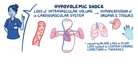 Shock - Hypovolemic: Nursing - Osmosis Video Library