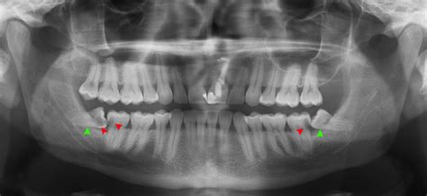 Wisdom Teeth 101: Impacted Wisdom Teeth Surgery