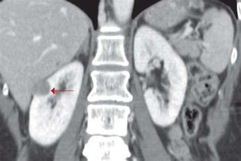 Kidney Tumor Ultrasound