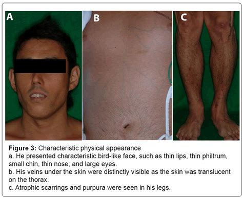 Pitfalls in the Diagnosis and Treatment of Non-Traumatic Hemoperitoneum | OMICS International