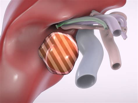 Laparoscopic right hepatectomy with Pringle maneuver - TVASurg - The Toronto Video Atlas of Surgery