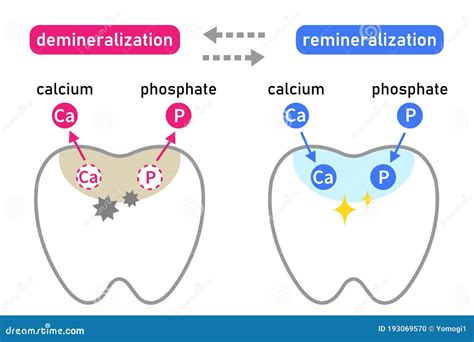 Diagram of Tooth Demineralization and Remineralization. Dental Care Concept Stock Vector ...