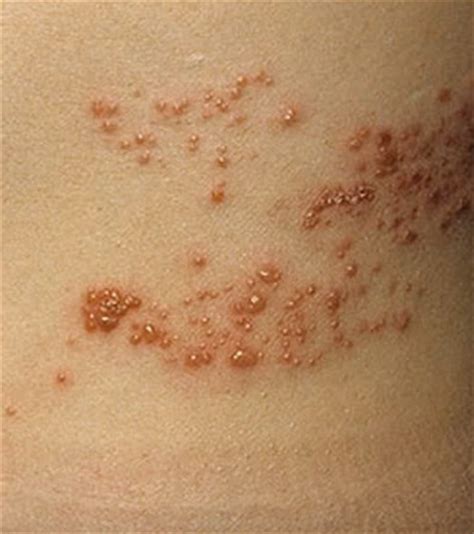 Sun Poisoning - Pictures, Rash Causes, Treatment | Health Momma