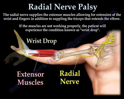 Radial Groove Radial Nerve