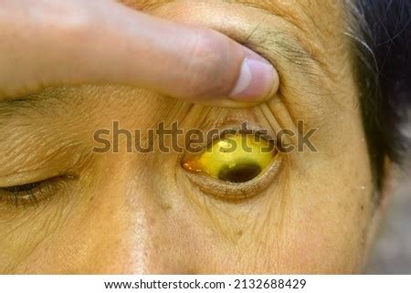 SCLERA Stock Photos and Images - Avopix.com