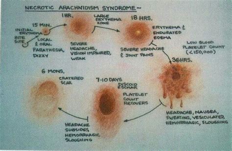 Spider Bite Visuals and Symptoms