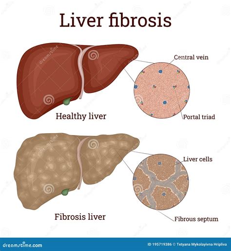 Fibrosis of the Liver stock vector. Illustration of liver - 195719386