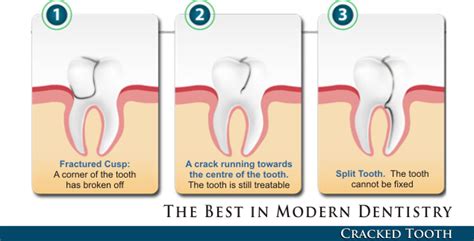 Cracked Tooth Syndrome – Dentist Downers Grove | General & Cosmetic Dentistry | Dentist Woodridge,IL