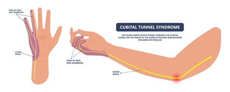 Radial Nerve Palsy - Dr Matty Wong Chiropractor Excel Medical Group