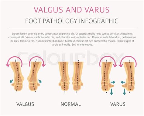 Foot deformation as medical desease ... | Stock vector | Colourbox