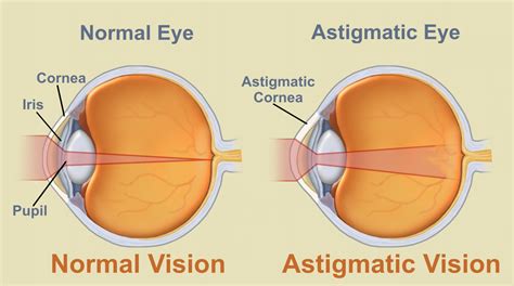 What Is Astigmatism? | GoSmartEyewear Blog