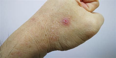 Papule: Causes, Symptoms, Treatments And Prevention Tips