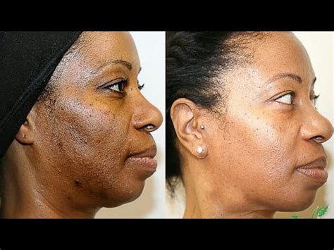 Skin lightening cream side effects | Steroid cream | Hydroquinone Cream ...