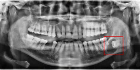 Why Do I Need An OPG? – Integrated Dental Health