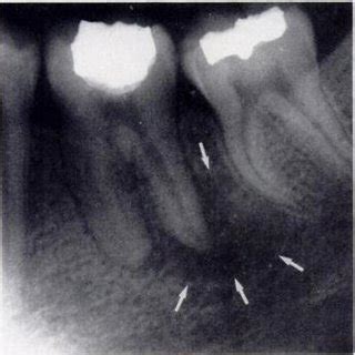 -Periapical abscess. lntraoral radiograph shows mandibular molar with... | Download Scientific ...