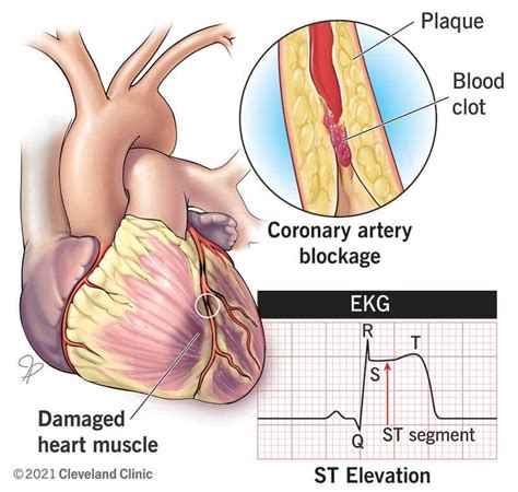 What is a STEMI Heart Attack?