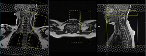 Brachial Plexus Anatomy Mri