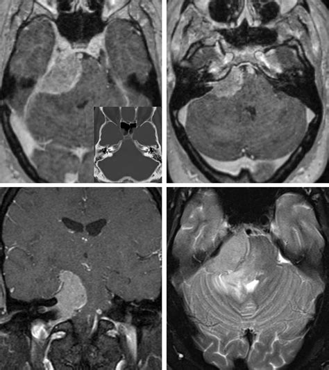 Petroclival Meningioma: Posterior Petrosal Approach | The Neurosurgical Atlas