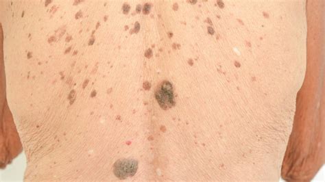 Age & Liver Spots: Symptoms, Causes, & Treatment - Toronto Dermatology ...