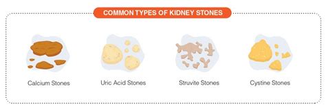 Overview of Kidney Stones - Signs, Symptoms, and Treatment