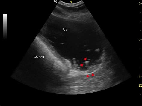 Ultrasonography of the Urinary Bladder