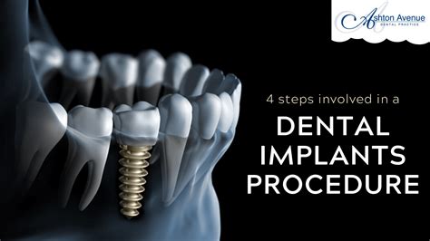 Dental Implant Procedure Step by Step - Missing Teeth Replacement | Claremont Dental Blog