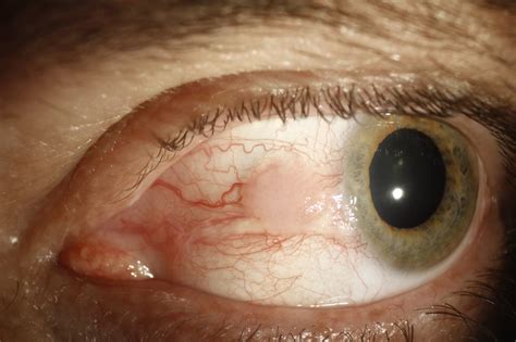 Ocular Surface Squamous Neoplasia1 - Eyes Wide Bay