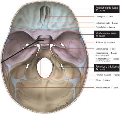 Types Of Skull Fracture