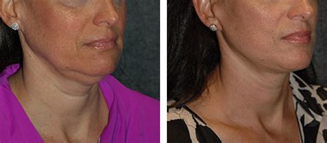 SMAS Facelift | Best SMAS Facelift Surgeon New York