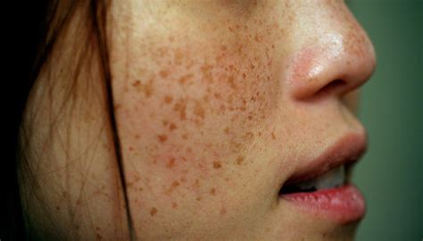 Freckles | Cheryl's freckles. | Frédéric Poirot | Flickr