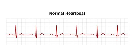 What Does An Abnormal ECG Mean? - Capital Heart Centre