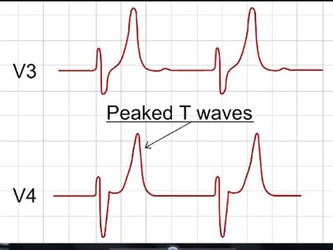 Hyperkalemia on ECG | ECG Findings of Hyperkalemia - YouTube