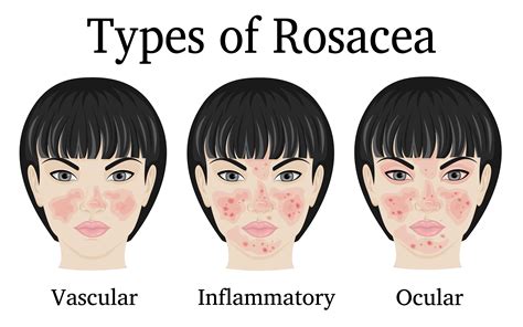 Rosacea Cheeks Treatment