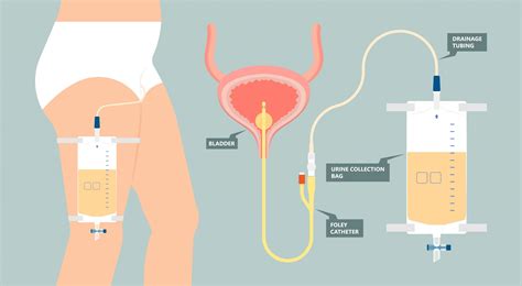 What's a Foley catheter? | Roswell Park Comprehensive Cancer Center - Buffalo, NY