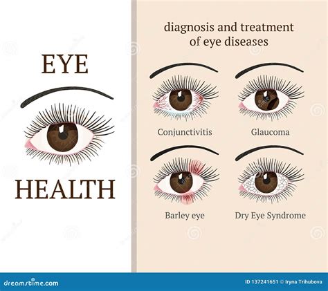 Conjunctivitis Types. Inflammatory Diseases Of Eyes Cartoon Vector ...