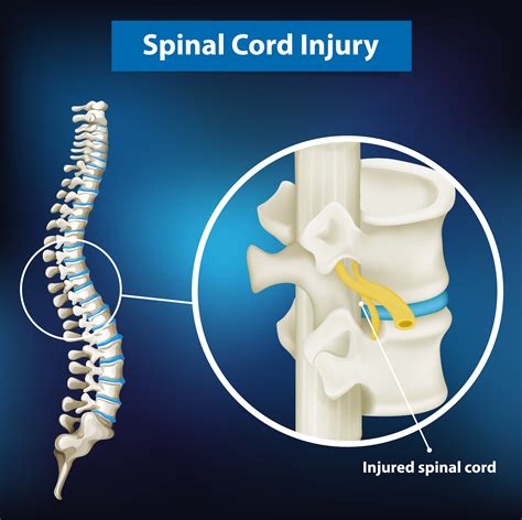 Diagram showing spinal cord injury 1235082 Vector Art at Vecteezy