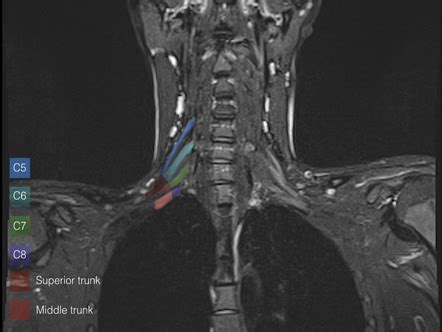 Ultrasound Of The Brachial Plexus Radiology Key | The Best Porn Website