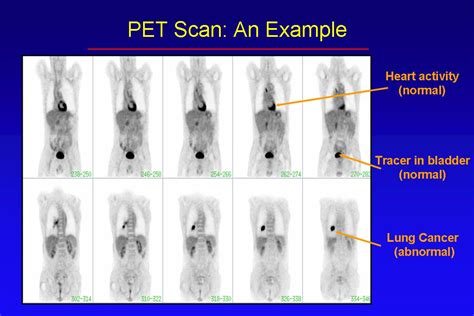 Pet Ct Scan Price - Captions Trendy