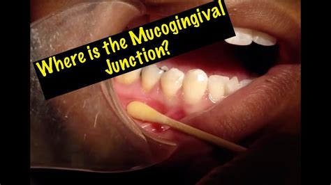 How do you find the Mucogingival Junction? - YouTube