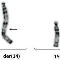 Array CGH images of chromosomes 14 and 15, involved in the... | Download Scientific Diagram