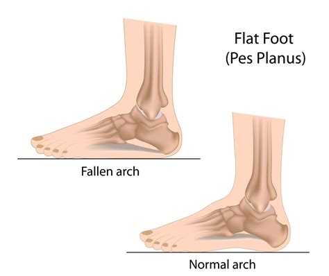 Foot Pain Caused by Flat Feet Can Be Treated | Healthmark Foot & Ankle Associates