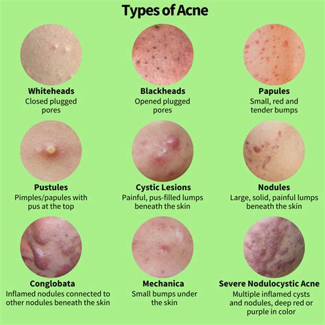 All About Acne Part 1: The Causes