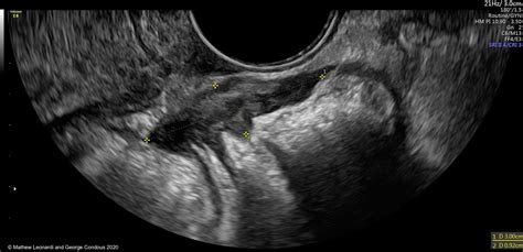 Noninvasive ultrasound diagnosis of endometriosis | Contemporary OB/GYN