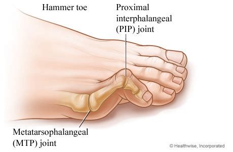 142. Congenital and acquired deformities of the foot - flat feet, bunion, hammer toe, club foot ...