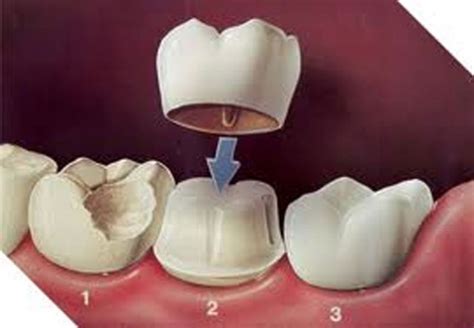 A Lost Tooth -Replace it with a Dental Crown – Vitamins Click