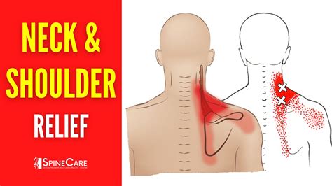 How to Fix Neck and Shoulder Pain FOR GOOD - YouTube