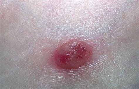 Seborrheic Keratosis - Causes, Symptoms, Home Treatment